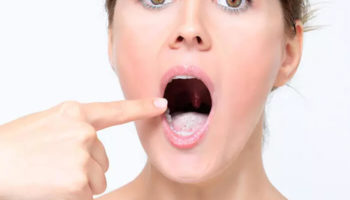 Cách điều trị bệnh lưỡi trắng